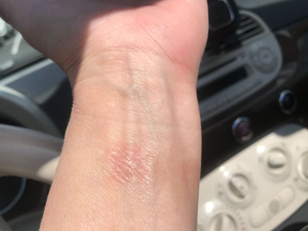 4 days after he initial burn from the shock of the fitbit