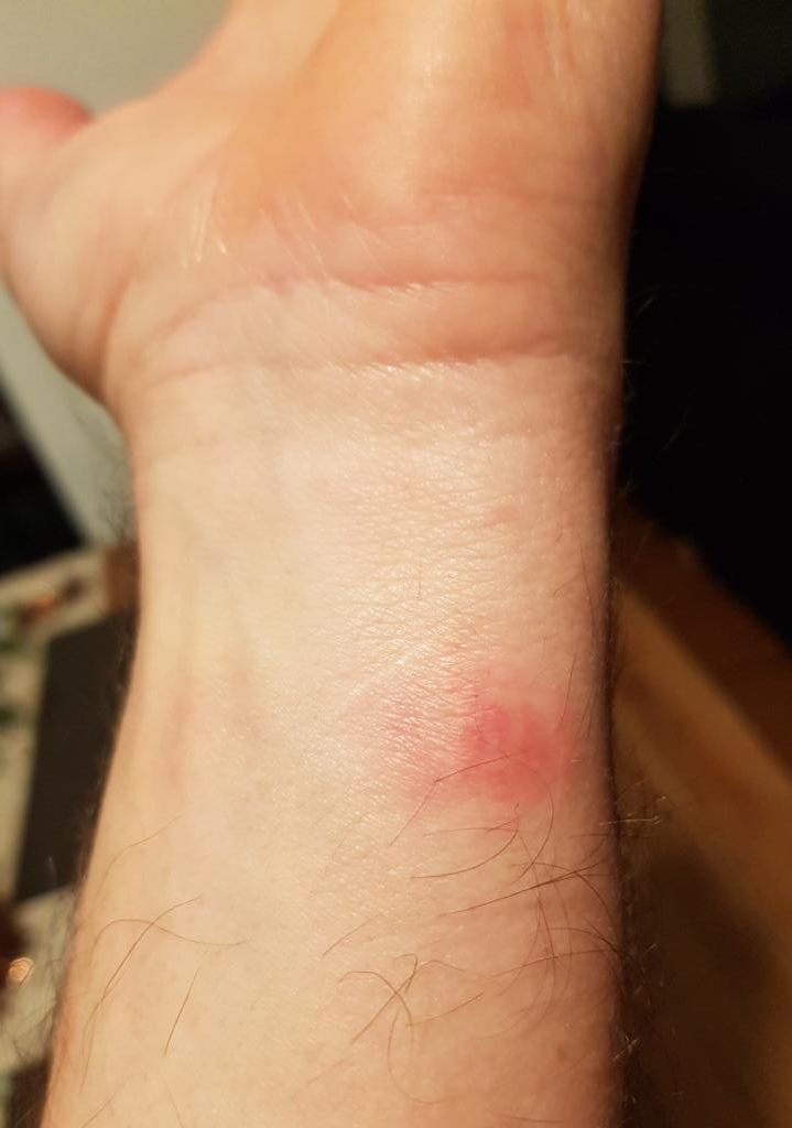 Ausschlag Armband Fitbit Sense Fitbit Community