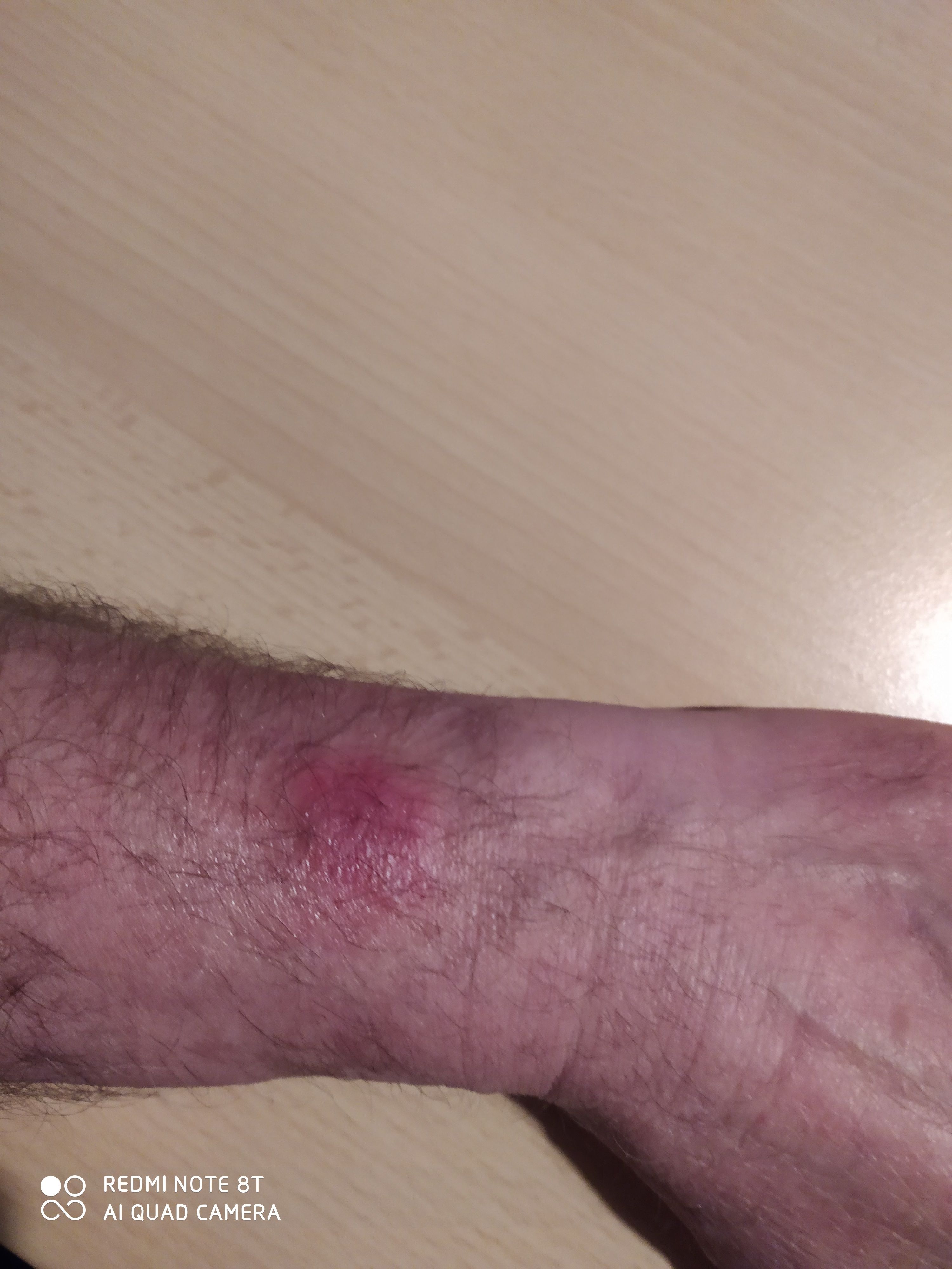 Ausschlag Armband Fitbit Sense Fitbit Community