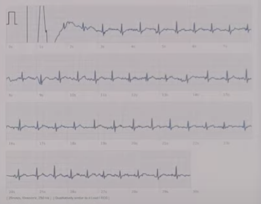 Fitbit with clearance ekg