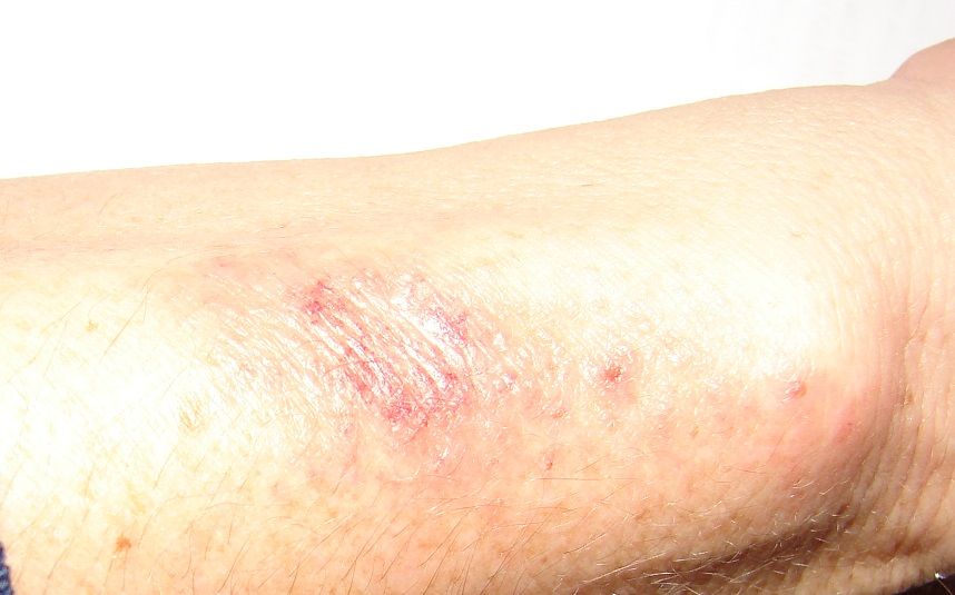 ArmRash.jpg