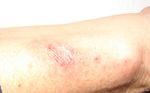 ArmRash.jpg
