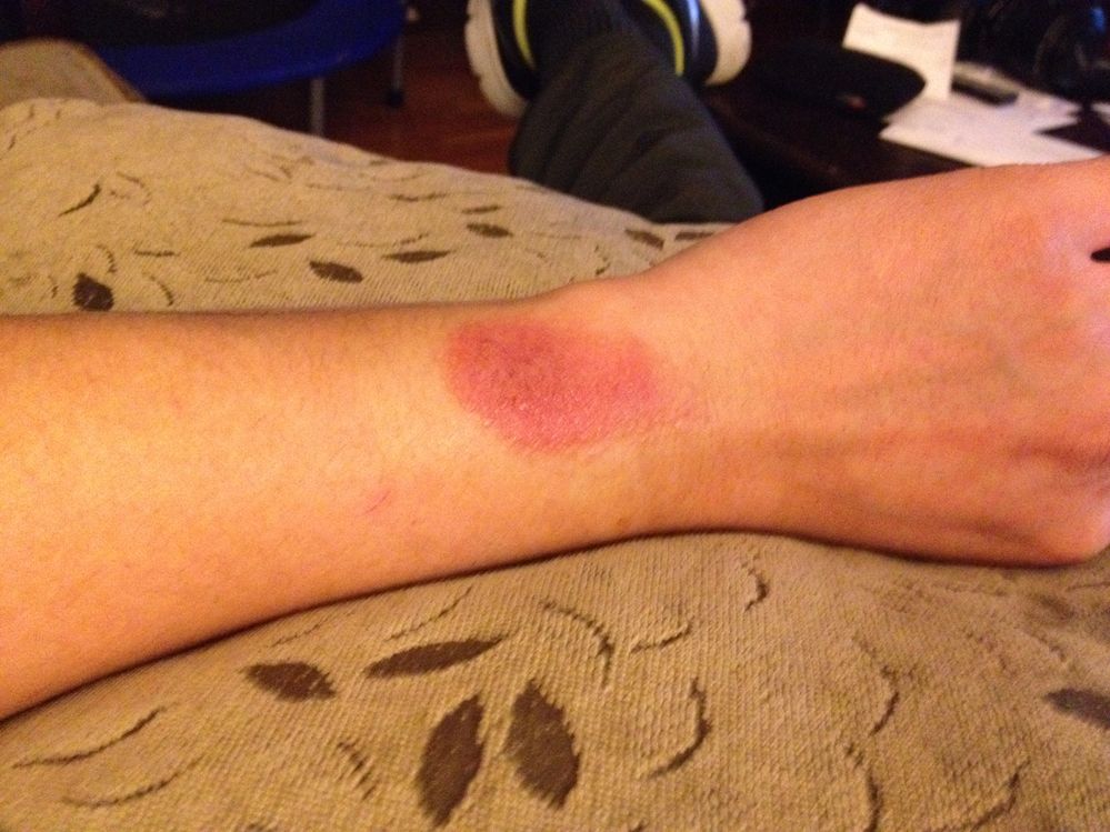 rash on wrist