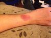 rash on wrist