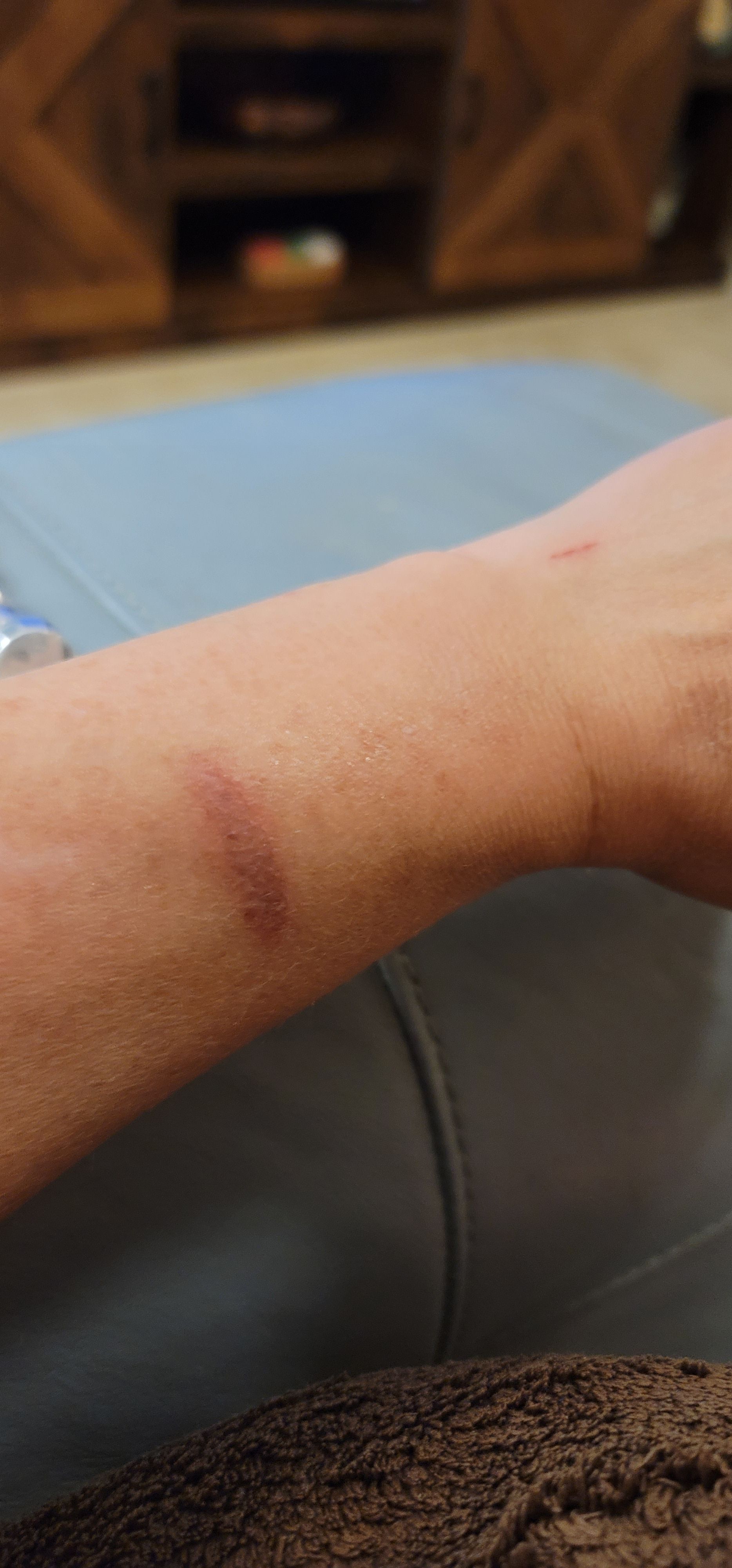 Experiencing skin irritation, or wrist... Fitbit Community