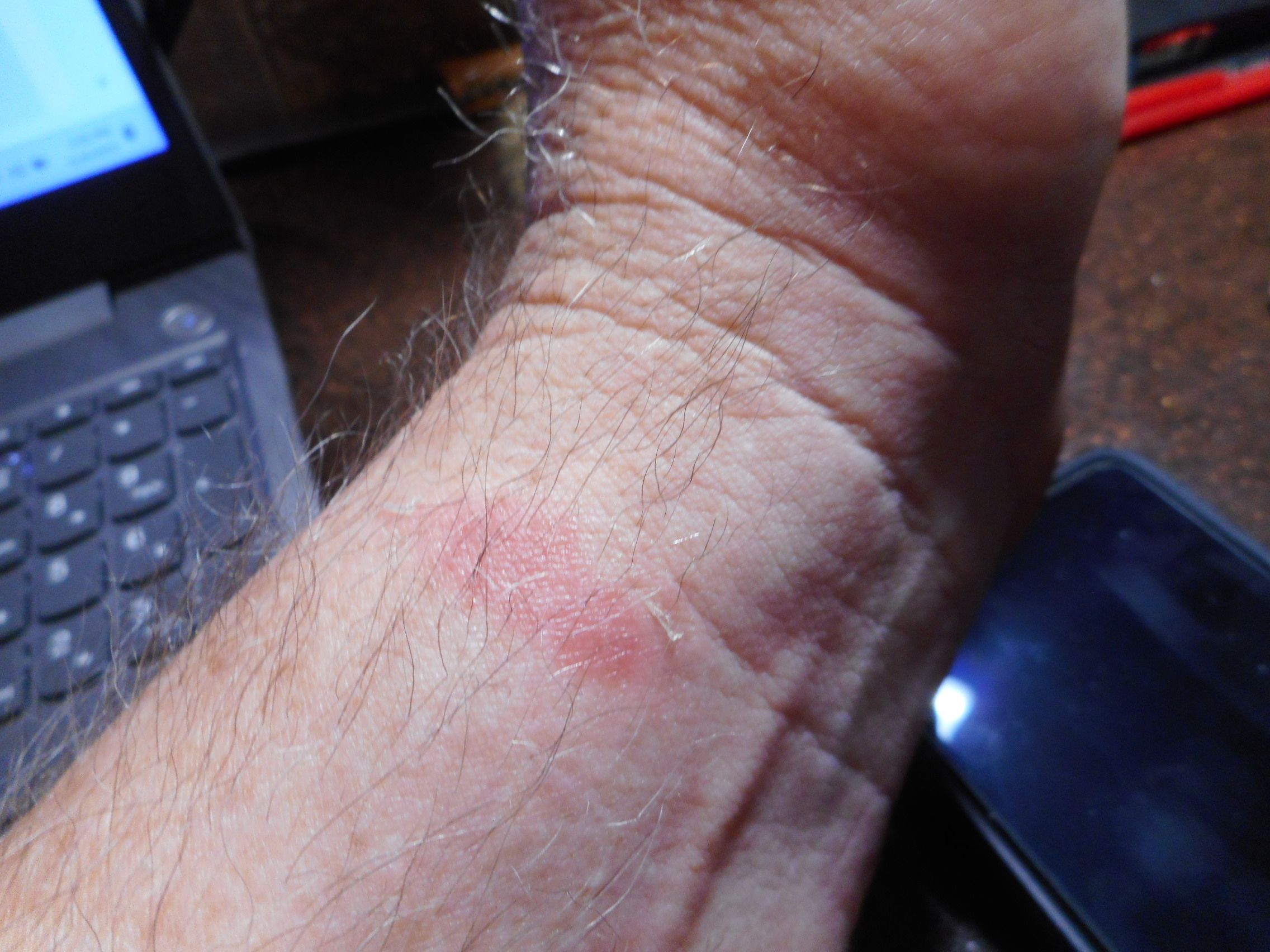 Experiencing skin irritation, or wrist... Fitbit Community