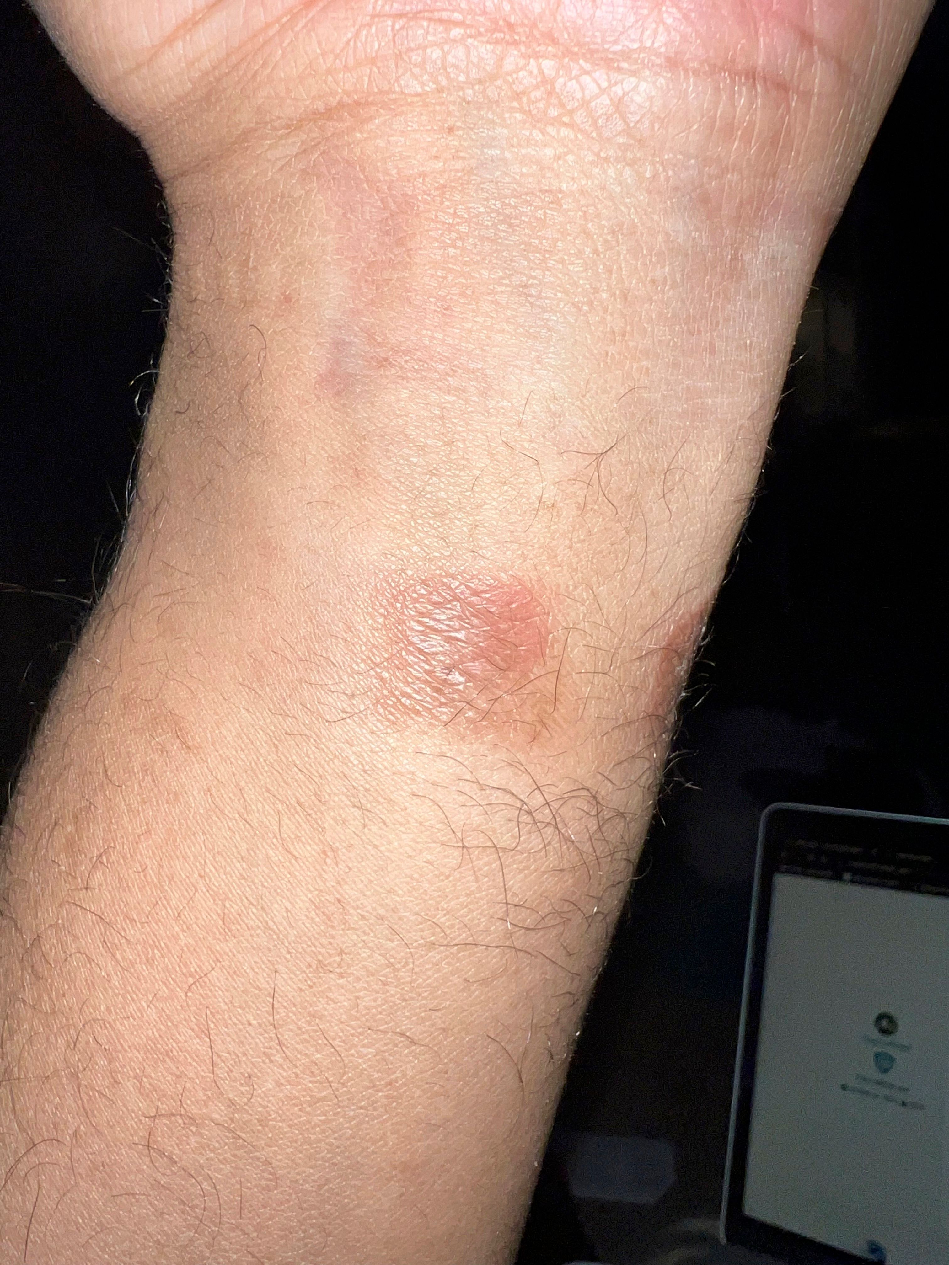 Experiencing skin irritation, or wrist... Fitbit Community