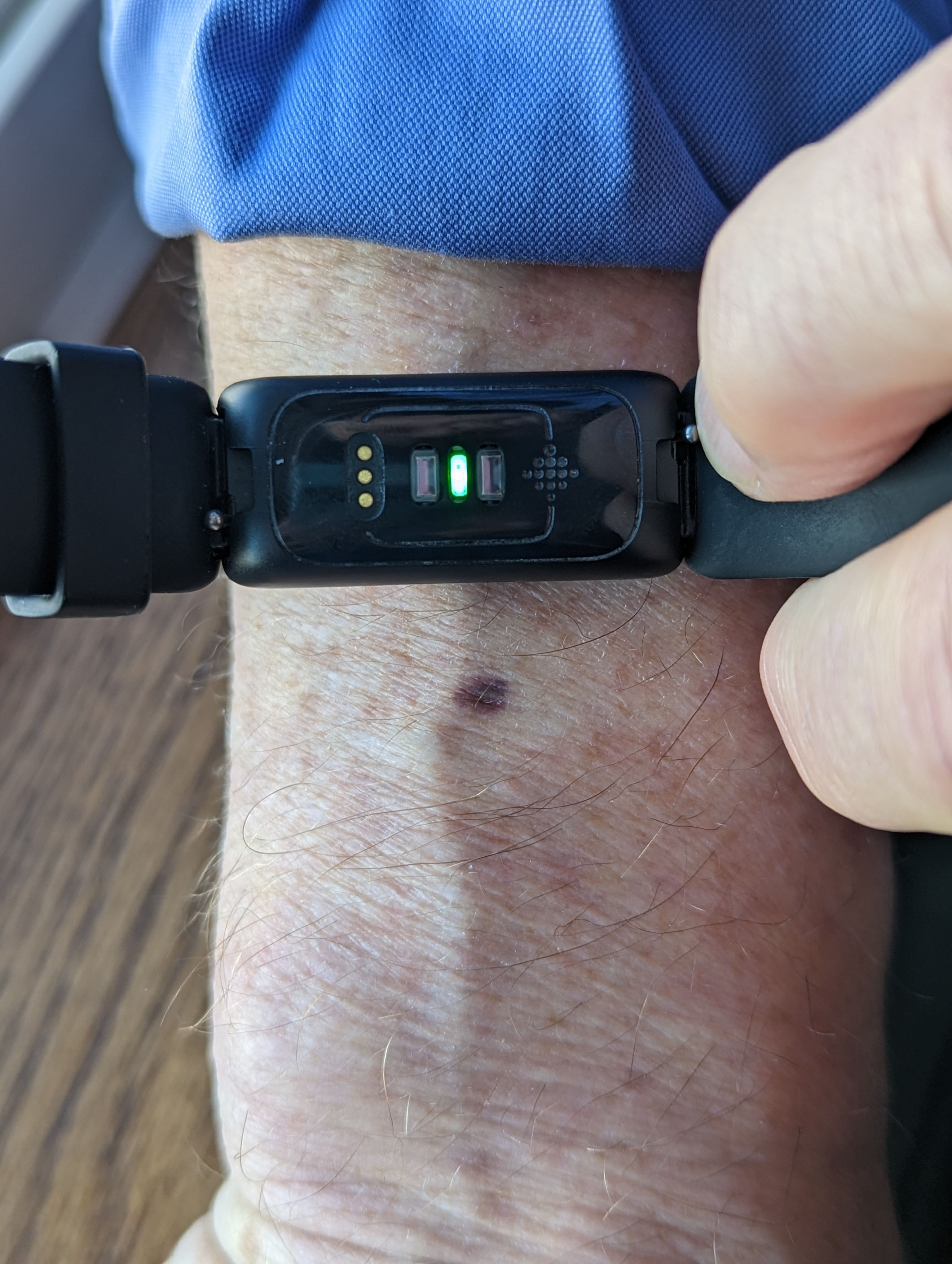 Experiencing skin irritation, or wrist... Fitbit Community