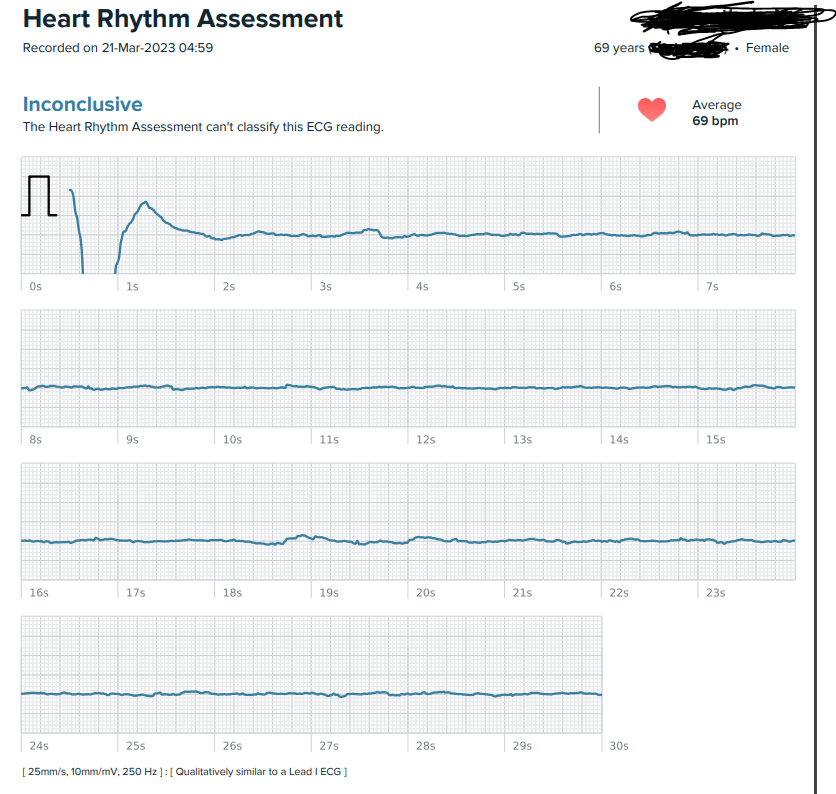 Fitbit ionic ecg 2025