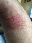 Skin irritation on side of wrist