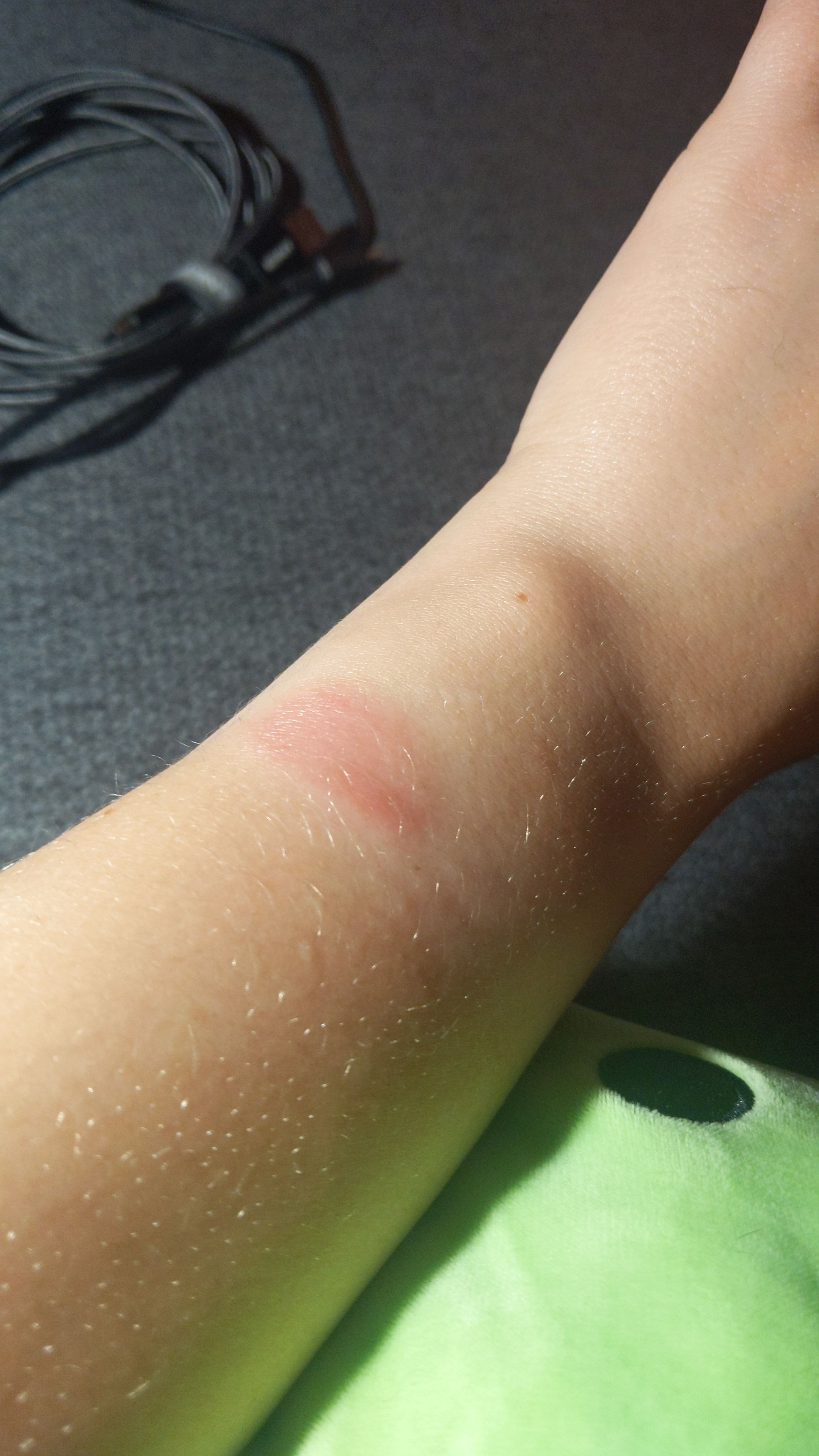 Allergic to fitbit online band