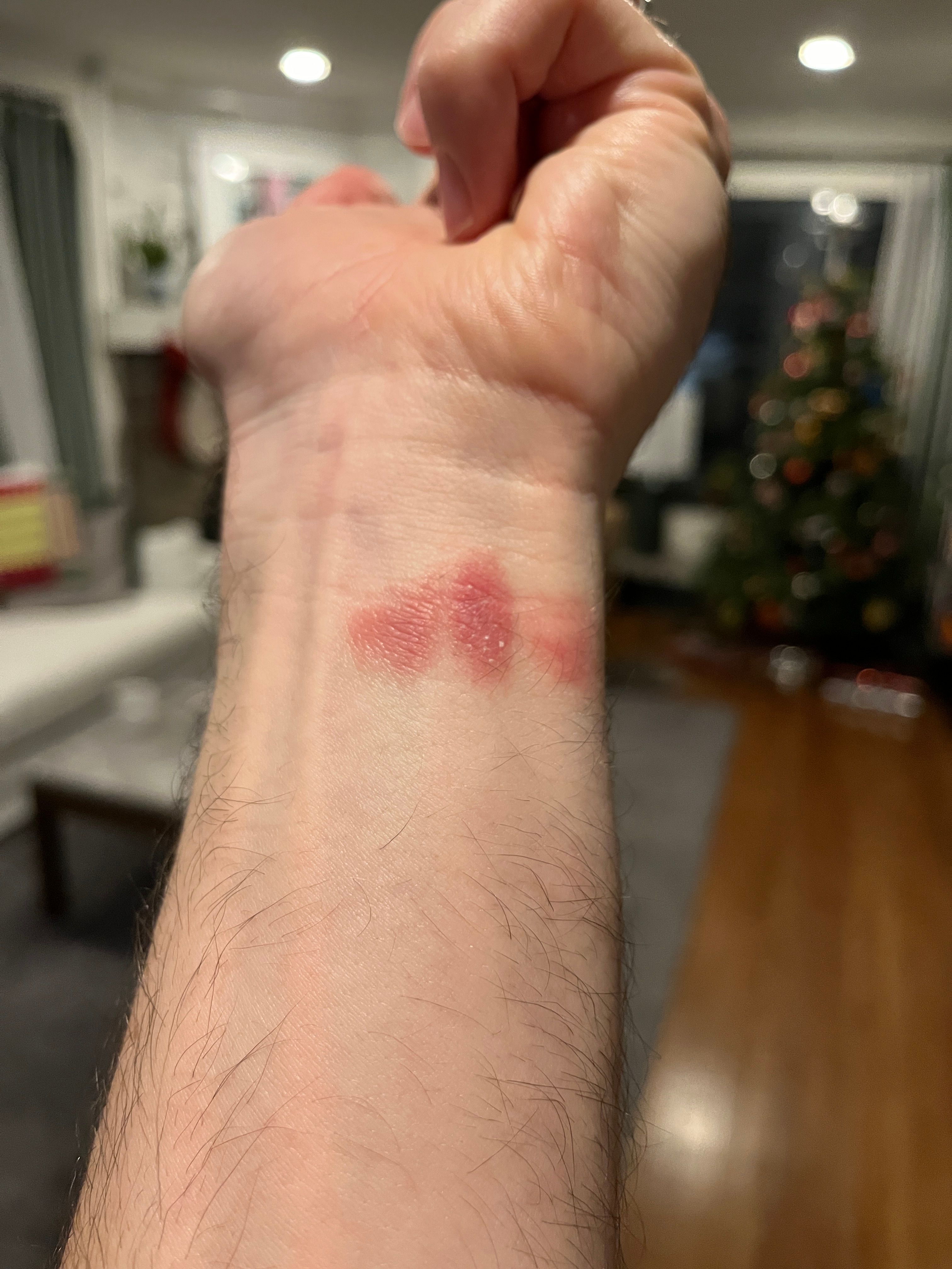 Rash from fitbit discount band