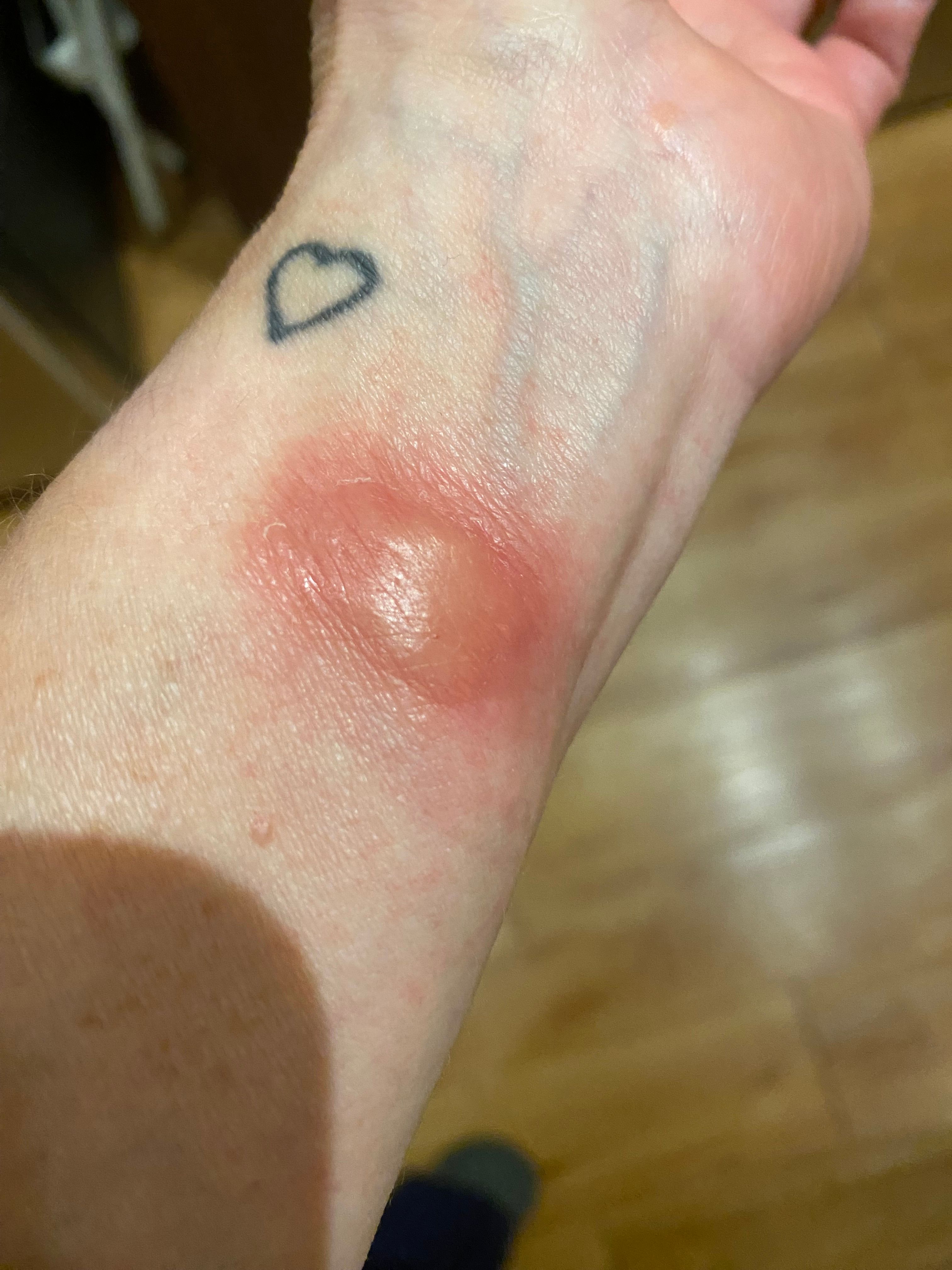 Experiencing skin discomfort irritation or wrist. Page 3 Fitbit Community