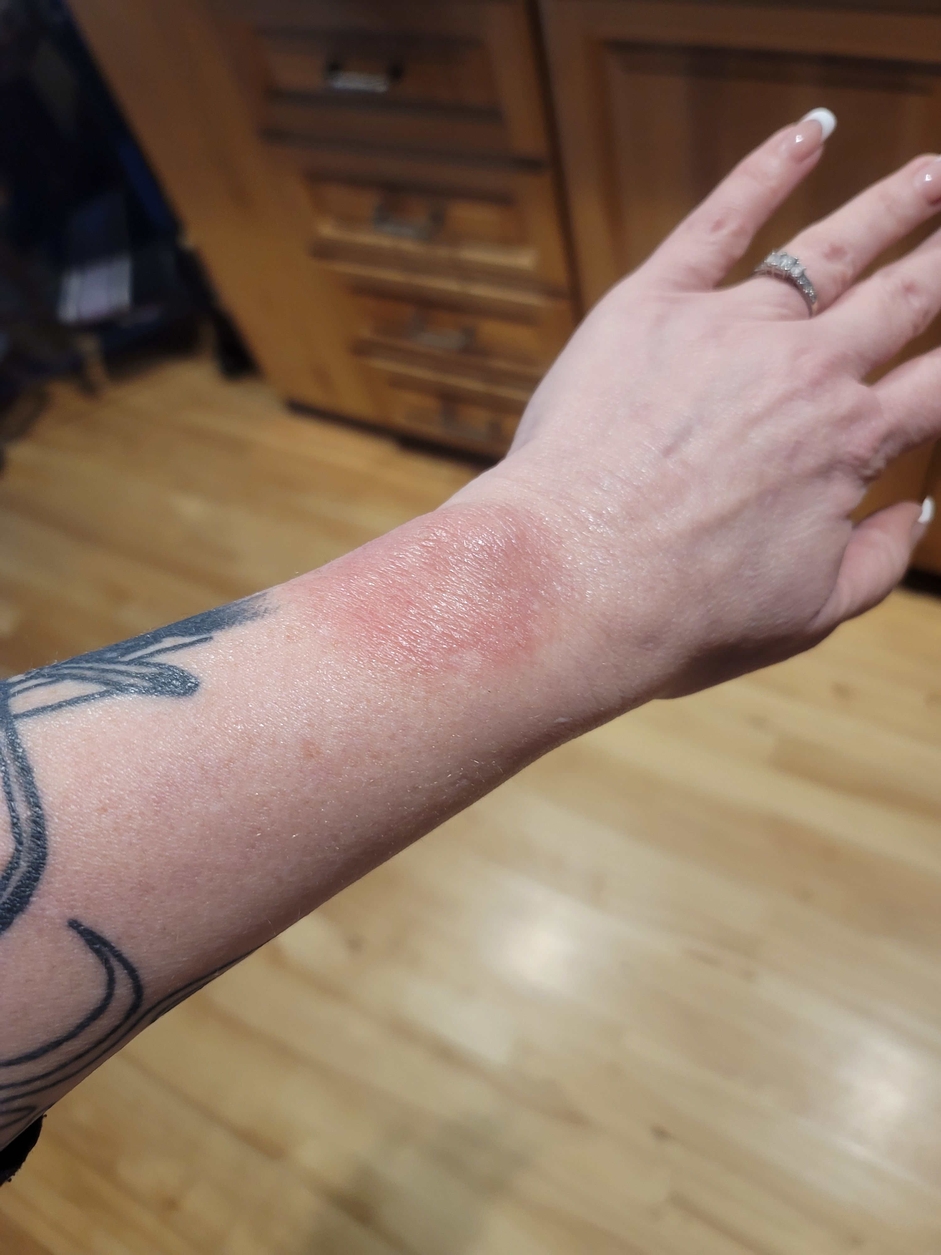 Has anyone ever got a rash like this from their Fitbit? More in