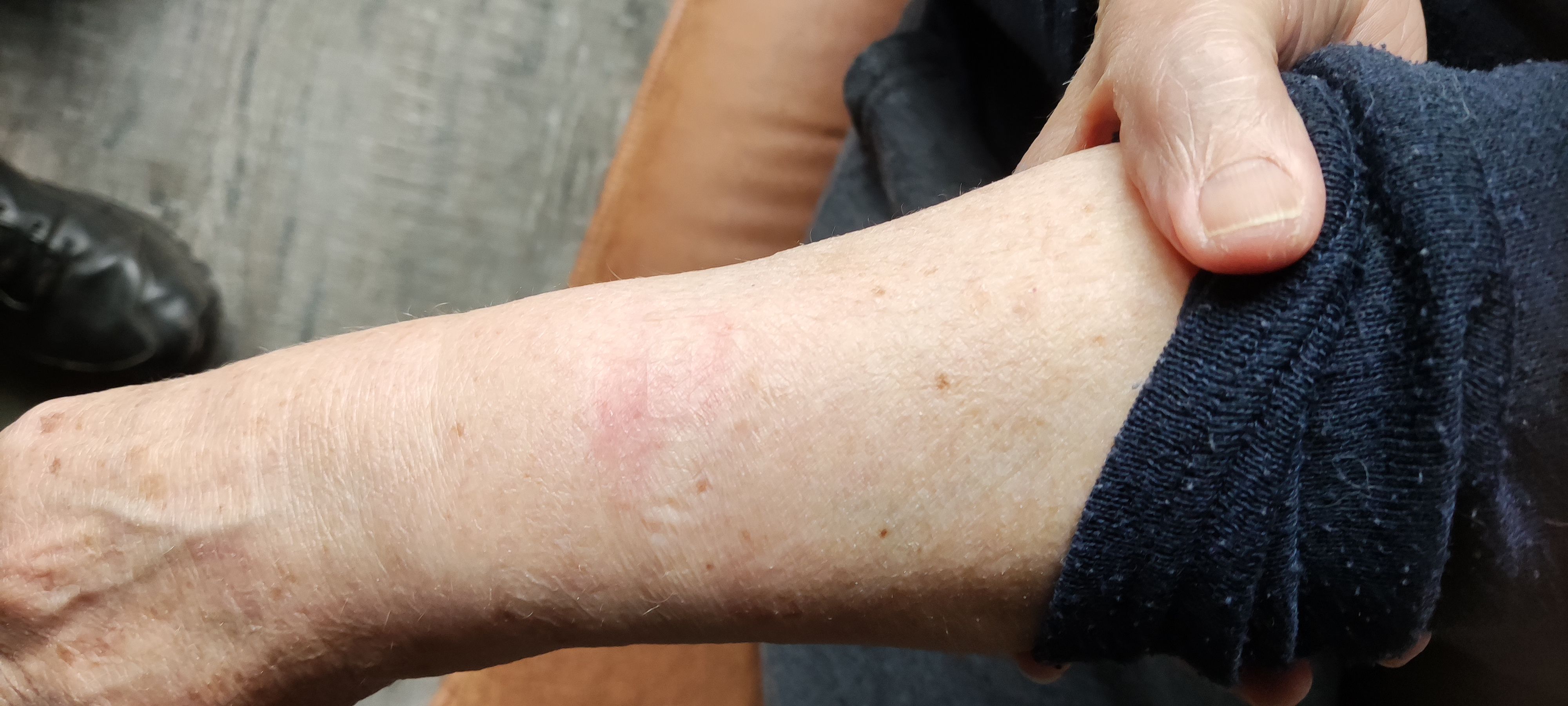 Fitbit Burn on Wrist: Causes, Symptoms, and How to Prevent It