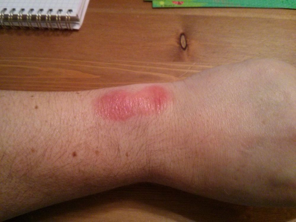 Rash