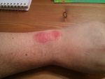 Rash