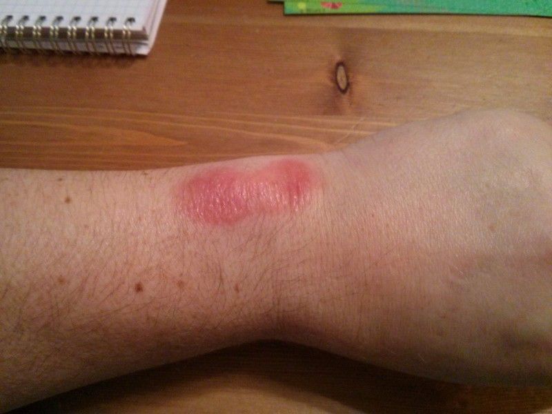 Rash