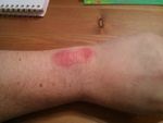 Rash