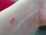 Red skin burn from FitBit Charge