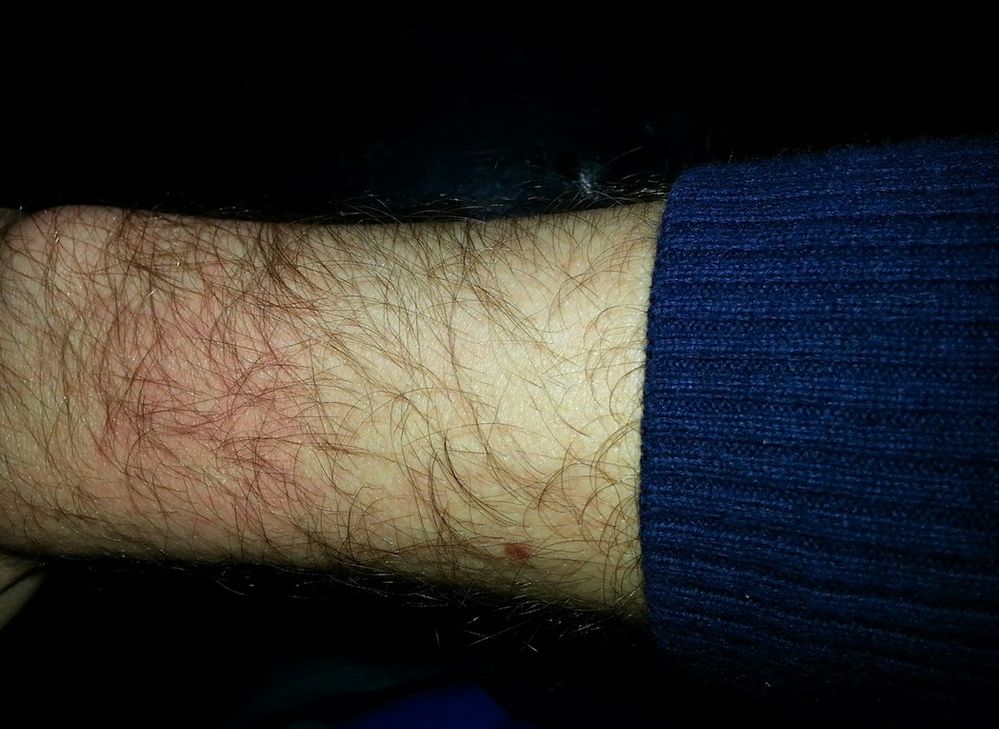 rash on wrist from force