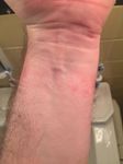 fitbit itchy rash