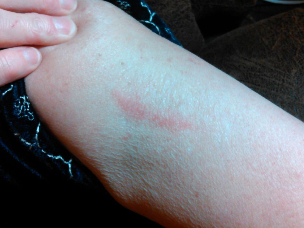 Skin Irritation