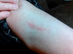 Skin Irritation