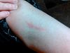 Skin Irritation