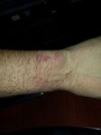 My Burned wrist