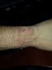 My Burned wrist