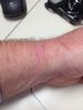 rash from Fitbit Force