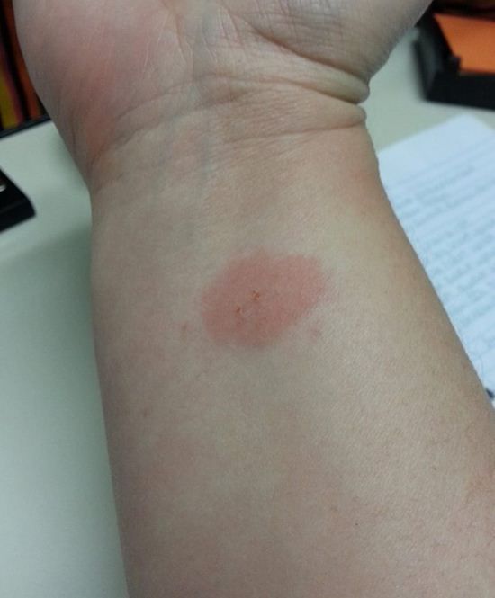 fitbit right wrist day 2 underside.JPG