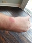 Before treatment
