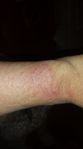 rash.jpg