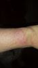 rash.jpg
