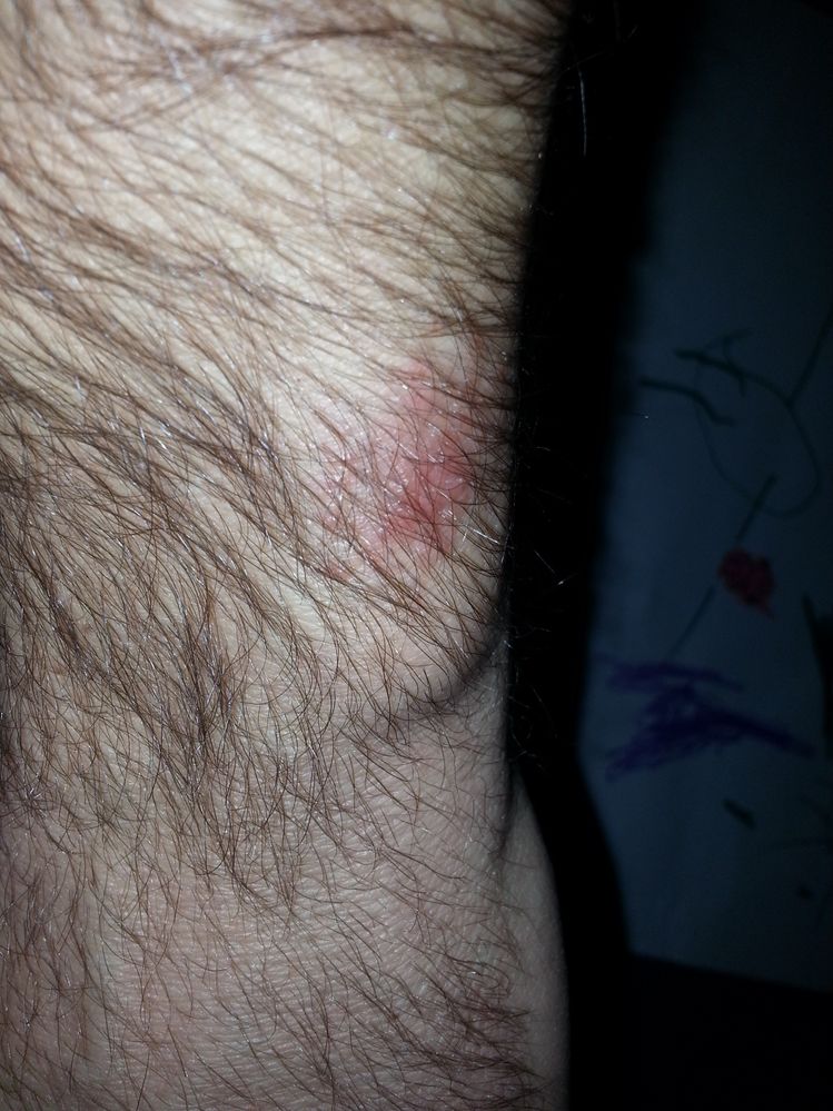 Fitbit Force Rash
