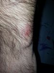 Fitbit Force Rash