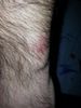 Fitbit Force Rash