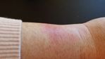 wrist with rash