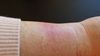 wrist with rash