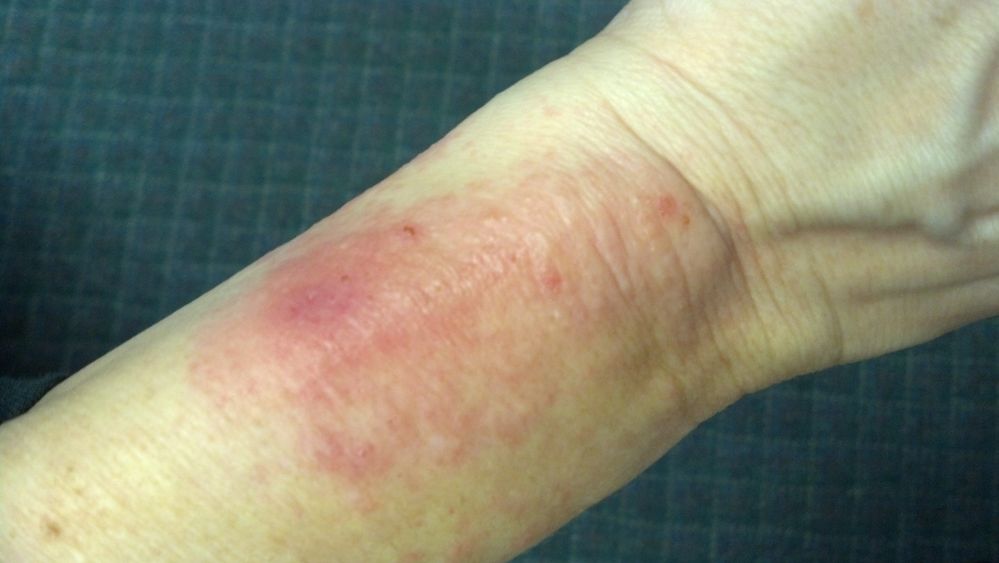 Gaines Fitbit Force Skin Reaction.jpg