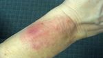 Gaines Fitbit Force Skin Reaction.jpg