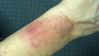 Gaines Fitbit Force Skin Reaction.jpg