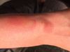 wristburn.JPG