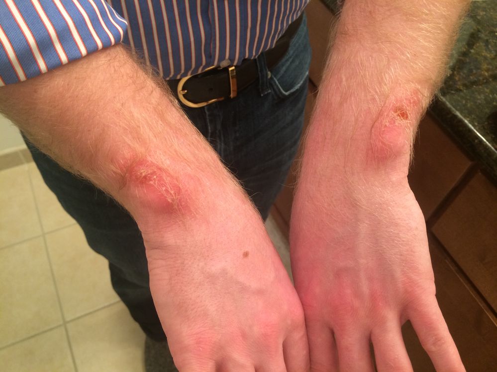 Impetigo from fitbit