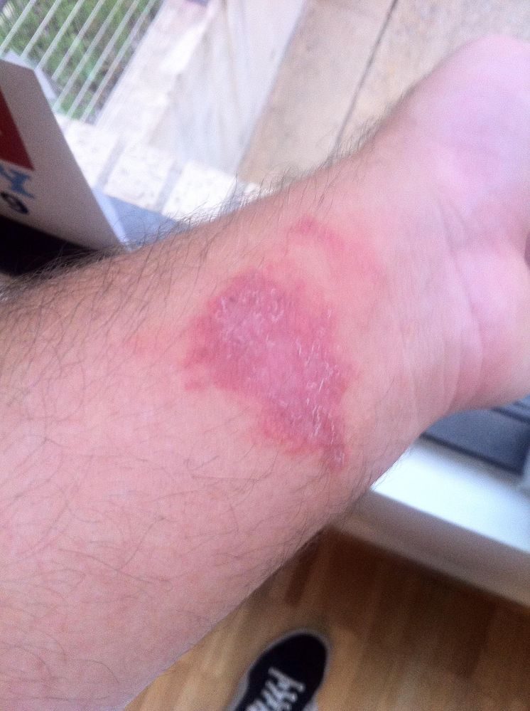 five weeks after the rash appeared