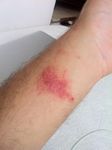 two weeks after first wearing Fitbit Force