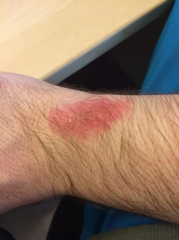 8 days after removing the Force, it has gotten worse over that time