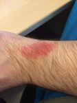 8 days after removing the Force, it has gotten worse over that time